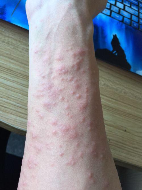 手上脚上长红点图片,探寻皮肤健康信号
