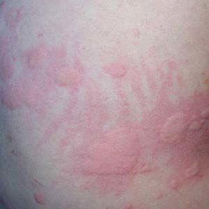 荨麻疹的症状和图片,识别与应对