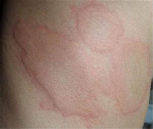 荨麻疹的症状和图片,识别与应对