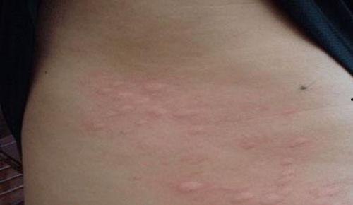 荨麻疹的症状和图片,识别与应对