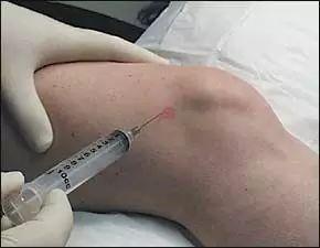 膝关节腔注射视频,膝关节腔注射操作步骤详解
