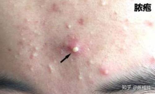 脓包型痤疮图片,图片解析与症状概述