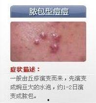 脓包型痤疮图片,图片解析与症状概述