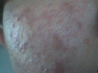 脓包型痤疮图片,图片解析与症状概述