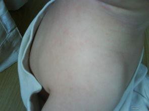 脸上泡疹的图片大全,症状与预防知识一览